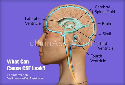 csf yellow fluid leaking from nose|Cerebrospinal Fluid (CSF) Leak